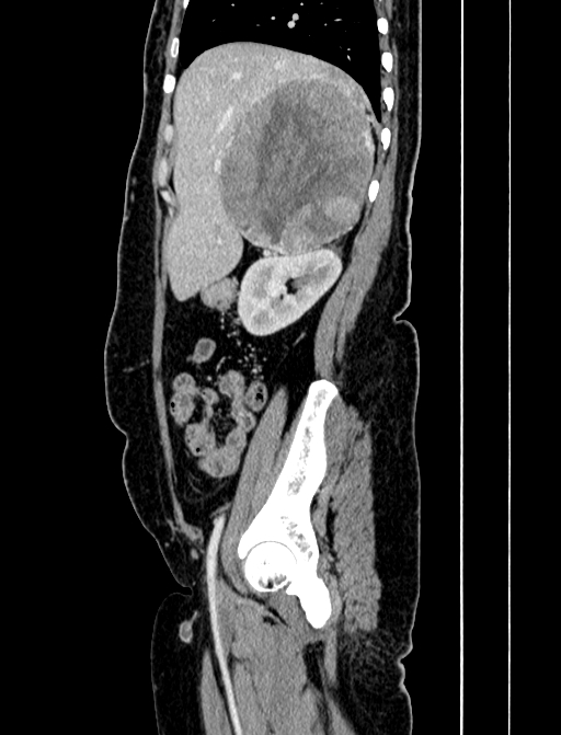 Adrenocortical carcinoma (Radiopaedia 87281-103569 Sagittal C+ portal venous phase 69).jpg
