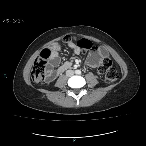 File:Adult transient intestinal intussusception (Radiopaedia 34853-36310 Axial C+ portal venous phase 50).jpg