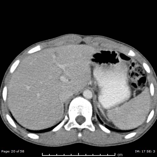 Agenesis of the gallbladder (Radiopaedia 55454-61905 B 20).jpg