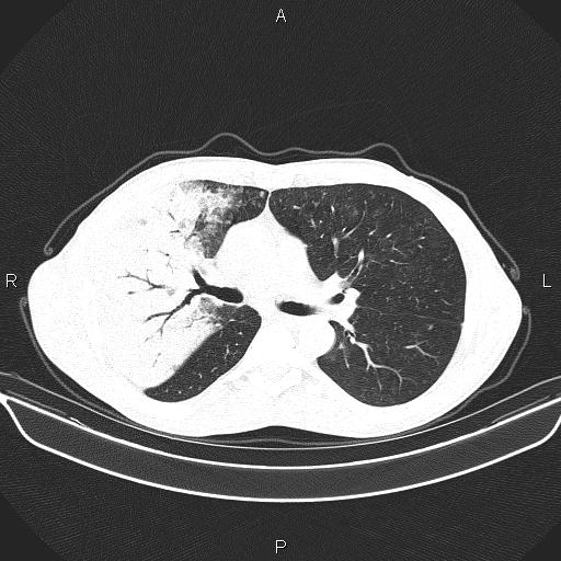 Air bronchogram in pneumonia (Radiopaedia 85719-101512 Axial lung window 30).jpg