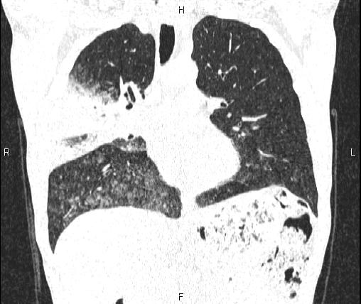 Air bronchogram in pneumonia (Radiopaedia 85719-101512 Coronal lung window 28).jpg