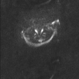 Alobar holoprosencephaly (Radiopaedia 52472-58384 Axial DWI and ADC 21).jpg