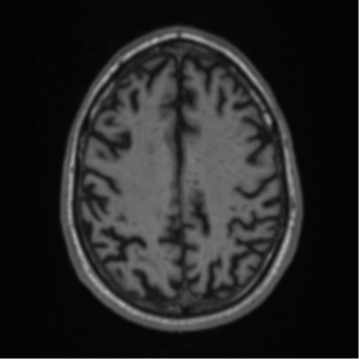 Alzheimer's disease- with Gerstmann syndrome and dressing apraxia (Radiopaedia 54882-61150 Axial T1 55).png