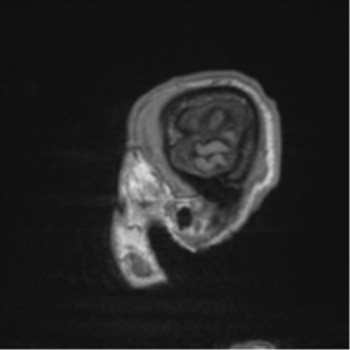 File:Alzheimer's disease- with apraxia (Radiopaedia 54763-61011 Sagittal T1 3).png