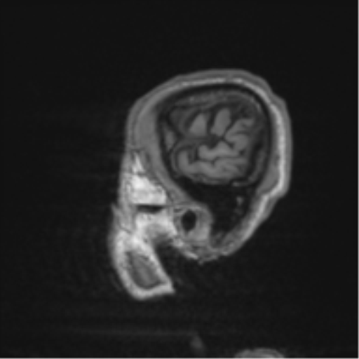 File:Alzheimer's disease- with apraxia (Radiopaedia 54763-61011 Sagittal T1 4).png