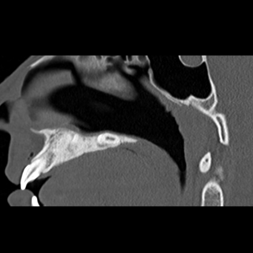 File:Ameloblastic fibro-odontoma (Radiopaedia 18843-18780 bone window 2).jpg