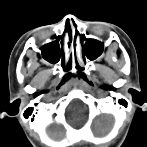 File:Ameloblastoma (Radiopaedia 26645-26793 Axial C+ delayed 34).jpg