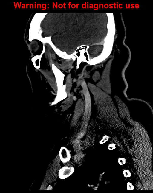 Ameloblastoma (Radiopaedia 33126-34164 F 52).jpg