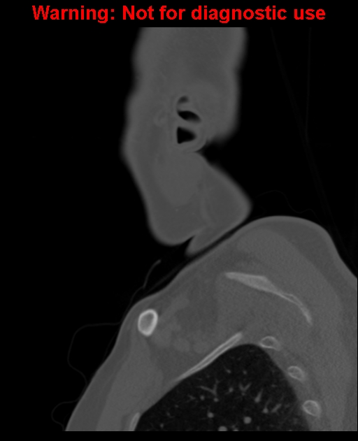 Ameloblastoma (Radiopaedia 33126-34164 Sagittal bone window 65).jpg