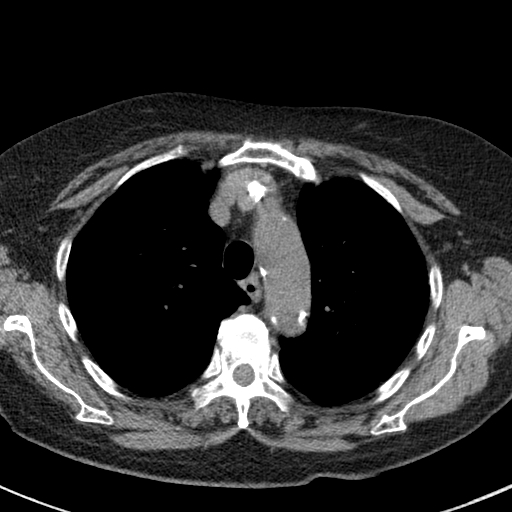 File:Amiodarone-induced pulmonary fibrosis (Radiopaedia 82355-96460 Axial non-contrast 20).jpg