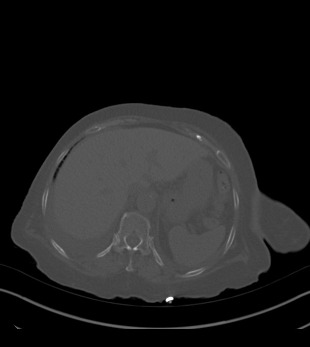 Amiodarone deposition in the liver (Radiopaedia 77587-89780 Axial bone window 75).jpg