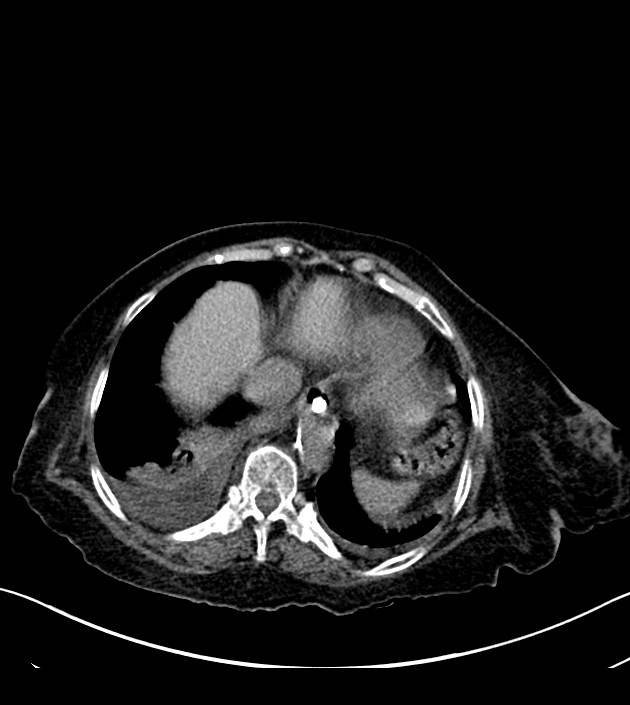 Amiodarone deposition in the liver (Radiopaedia 77587-89780 Axial non-contrast 66).jpg