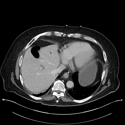 Ampullary adenocarcinoma (Radiopaedia 59373-66737 A 28).jpg
