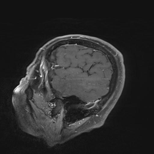 Amyloid angiopathy with inflammation (Radiopaedia 30360-31002 M 152).jpg