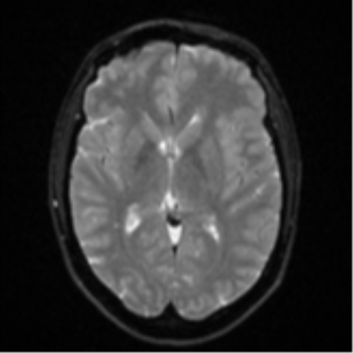 File:Anaplastic astrocytoma (Radiopaedia 57768-64731 Axial DWI 14).png