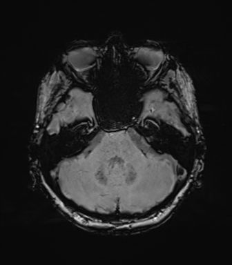 Anaplastic astrocytoma (Radiopaedia 86943-103160 Axial SWI 26).png