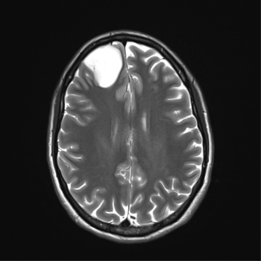 File:Anaplastic astrocytoma IDH mutant (Radiopaedia 50046-55341 Axial T2 26).png