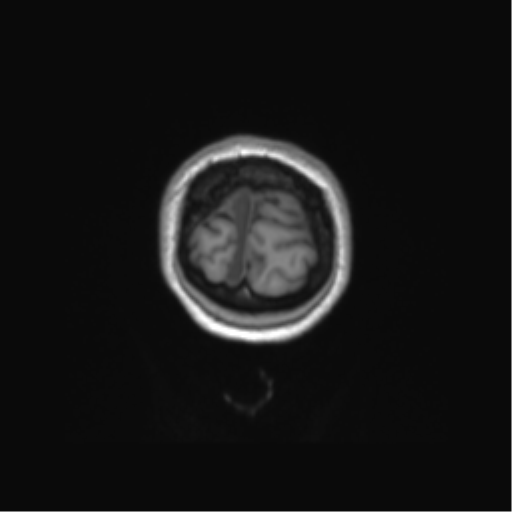 Anaplastic astrocytoma IDH mutant (Radiopaedia 50046-55341 Coronal T1 5).png