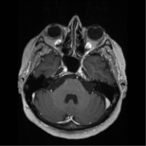 File:Anaplastic astrocytoma IDH wild-type (pseudoprogression) (Radiopaedia 42209-45276 Axial T1 C+ 45).png