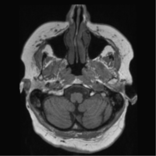 File:Anaplastic astrocytoma IDH wild-type (pseudoprogression) (Radiopaedia 42209-45278 Axial T1 30).png