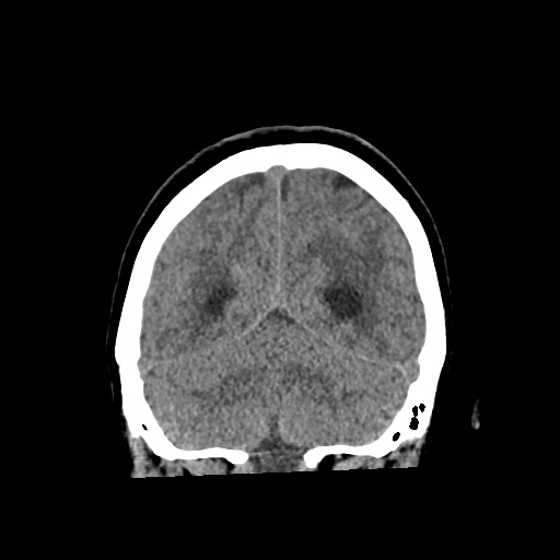 File:Aneursym related subarachnoid hemorrhage with hydrocephalus (Radiopaedia 45105-49083 Coronal non-contrast 51).jpg