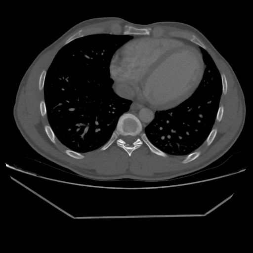 Aneurysmal bone cyst - rib (Radiopaedia 82167-96220 Axial bone window 178).jpg