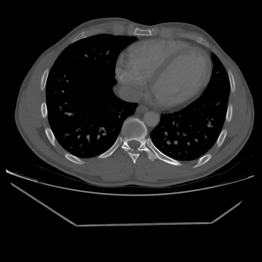 File:Aneurysmal bone cyst - rib (Radiopaedia 82167-96220 Axial bone window 181).jpg
