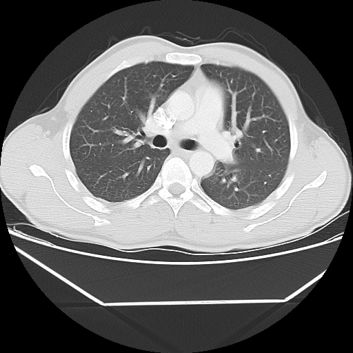 Aneurysmal bone cyst - rib (Radiopaedia 82167-96220 Axial lung window 30).jpg