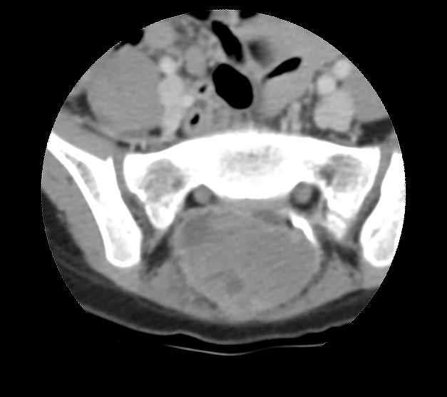 Aneurysmal bone cyst - sacrum (Radiopaedia 65190-74195 Axial non-contrast 20).jpg