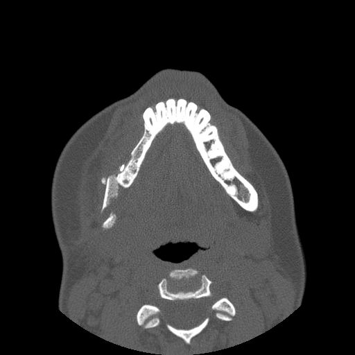 File:Aneurysmal bone cyst of the mandible (Radiopaedia 43280-46823 Axial bone window 46).jpg
