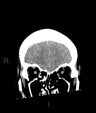 File:Aneurysmal subarachnoid hemorrhage with intra-axial extension (Radiopaedia 84371-99699 Coronal non-contrast 54).jpg