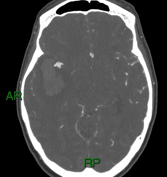 File:Aneurysmal subarachnoid hemorrhage with intra-axial extension (Radiopaedia 84371-99732 A 26).jpg