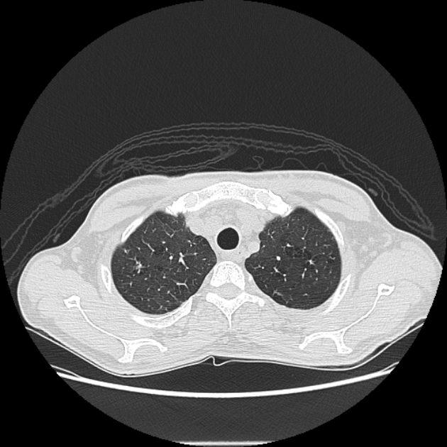 Angioinvasive aspergellosis (Radiopaedia 66995-76315 Axial lung window 6).jpg