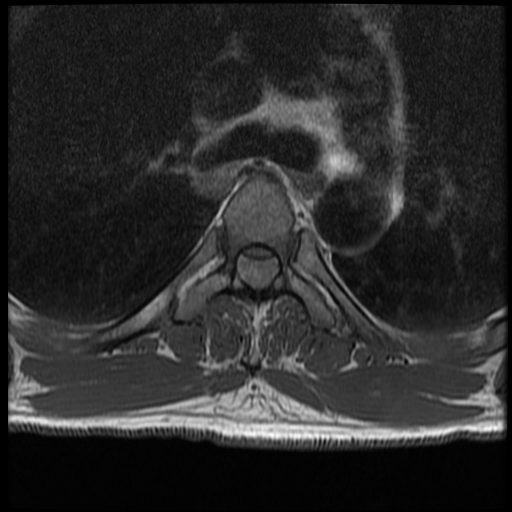 File:Angiolipoma - thoracic spine (Radiopaedia 28242-28479 Axial T1 19).jpg