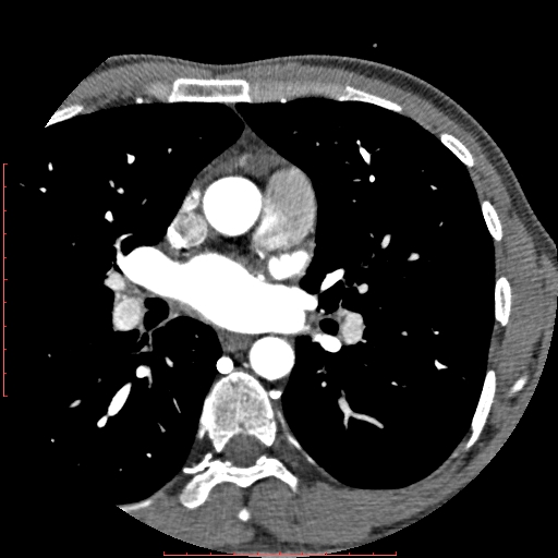 Anomalous left coronary artery from the pulmonary artery (ALCAPA) (Radiopaedia 70148-80181 A 50).jpg