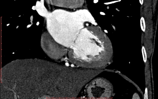Anomalous left coronary artery from the pulmonary artery (ALCAPA) (Radiopaedia 70148-80181 B 166).jpg