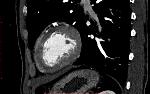 Anomalous left coronary artery from the pulmonary artery (ALCAPA) (Radiopaedia 70148-80181 C 201).jpg