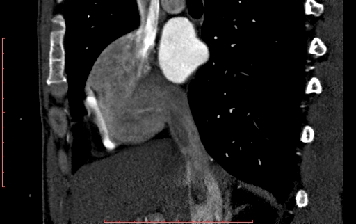 File:Anomalous left coronary artery from the pulmonary artery (ALCAPA) (Radiopaedia 70148-80181 C 40).jpg