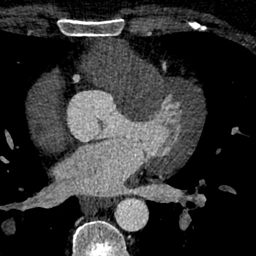 File:Anomalous origin of the left coronary artery with malignant course (Radiopaedia 77842-90126 C 100).jpeg