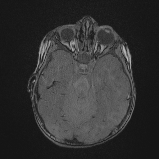 File:Anoxic brain injury (Radiopaedia 79165-92139 Axial MRA 76).jpg