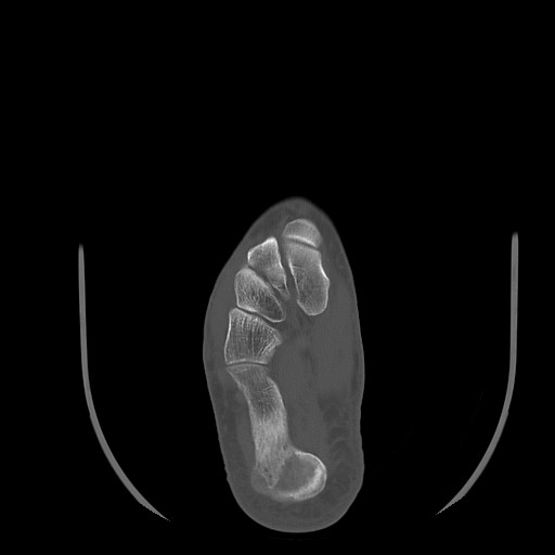File:Anterior calcaneal process fracture (Radiopaedia 82590-96762 Axial bone window 28).jpg