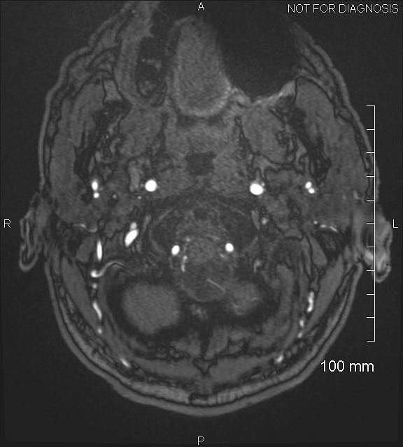 Anterior cerebral artery aneurysm (Radiopaedia 80683-94127 Axial MRA 3).jpg