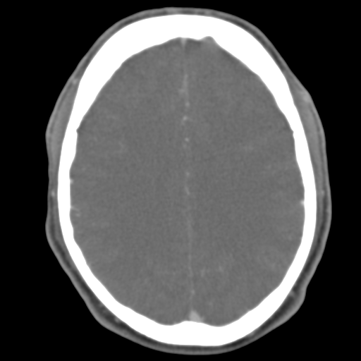 File:Anterior cerebral artery territory infarct (Radiopaedia 39327-41581 B 23).png