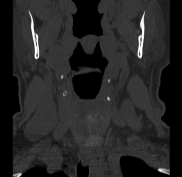 Anterior cervical postdiscectomy arthrodesis (Radiopaedia 32678-33646 Coronal bone window 3).jpg