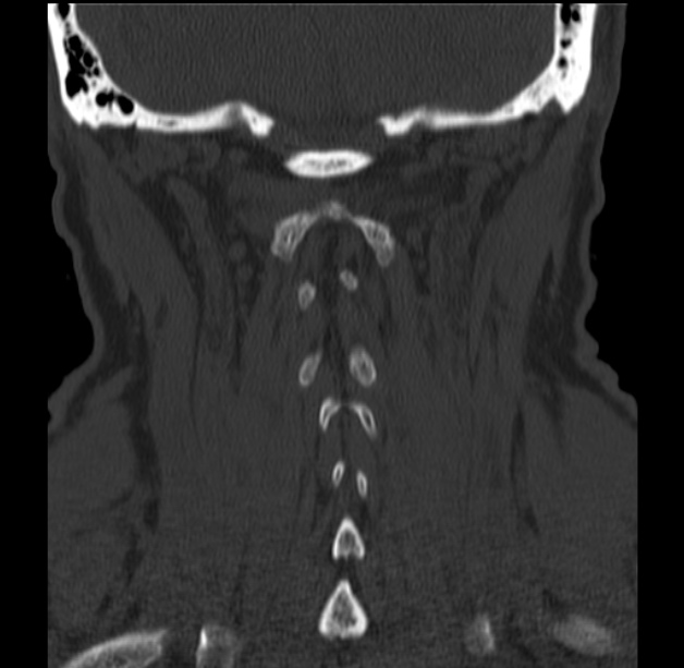 Anterior cervical postdiscectomy arthrodesis (Radiopaedia 32678-33646 Coronal bone window 55).jpg