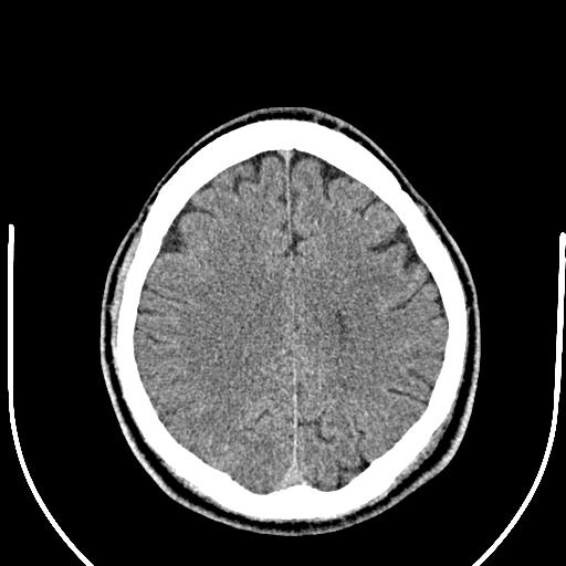 Anterior choroidal artery infarct (Radiopaedia 55106-61480 Axial non-contrast 42).jpg