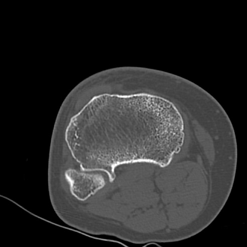 File:Anterior cruciate ligament avulsion fracture (Radiopaedia 58939-66194 Axial bone window 26).jpg