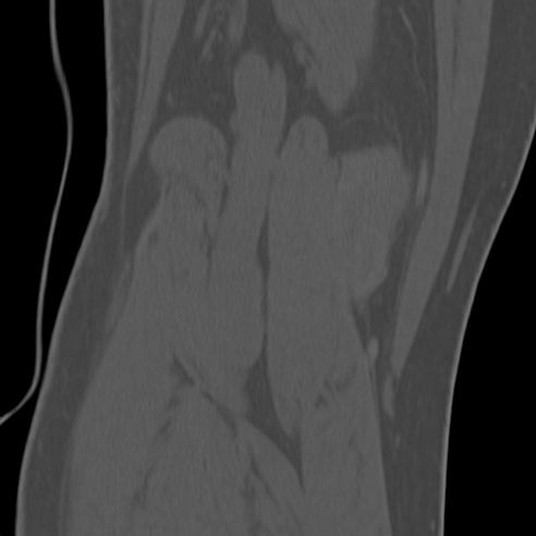 File:Anterior cruciate ligament avulsion fracture (Radiopaedia 58939-66194 Coronal bone window 31).jpg