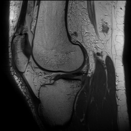 Anterior cruciate ligament rupture with Segond fracture (Radiopaedia 69043-78806 Sagittal PD 116).jpg