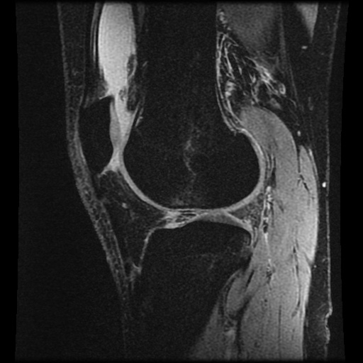 Anterior cruciate ligament tear (Radiopaedia 61500-69462 F 61).jpg